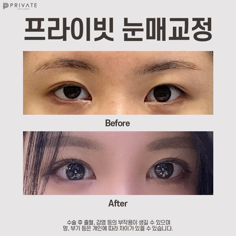 눈매교정쌍수잘하는곳 프라이빗성형외과 사진 9