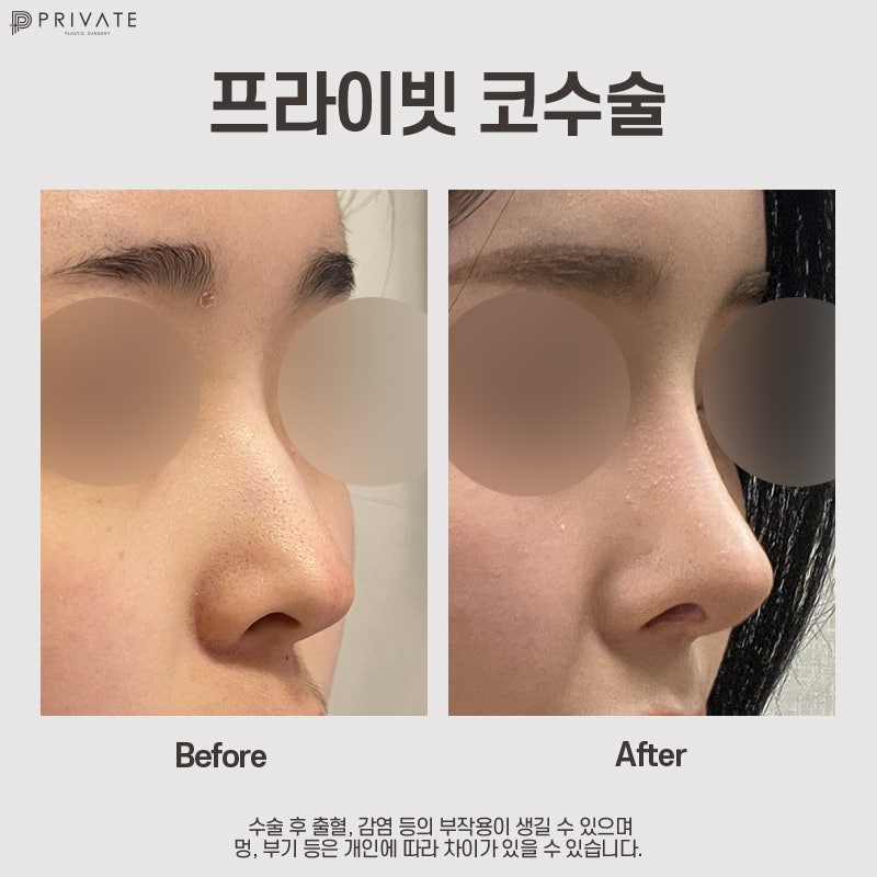 Ulasan Operasi Hidung Rendah di Private Plastic Surgery 사진 8