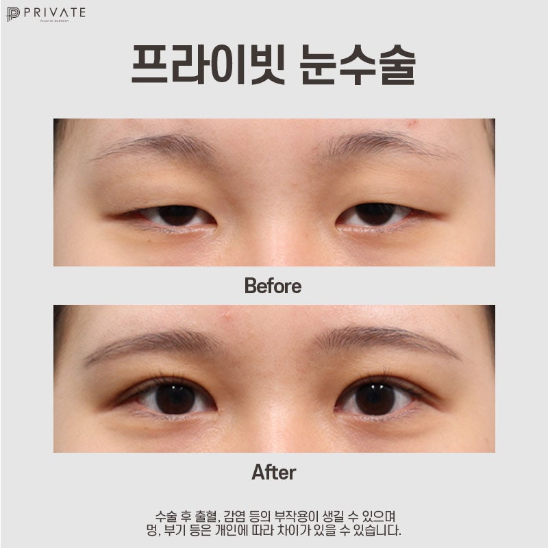 Perbandingan ulasan operasi koreksi mata di Private Plastic Surgery adalah yang terbaik 사진 8