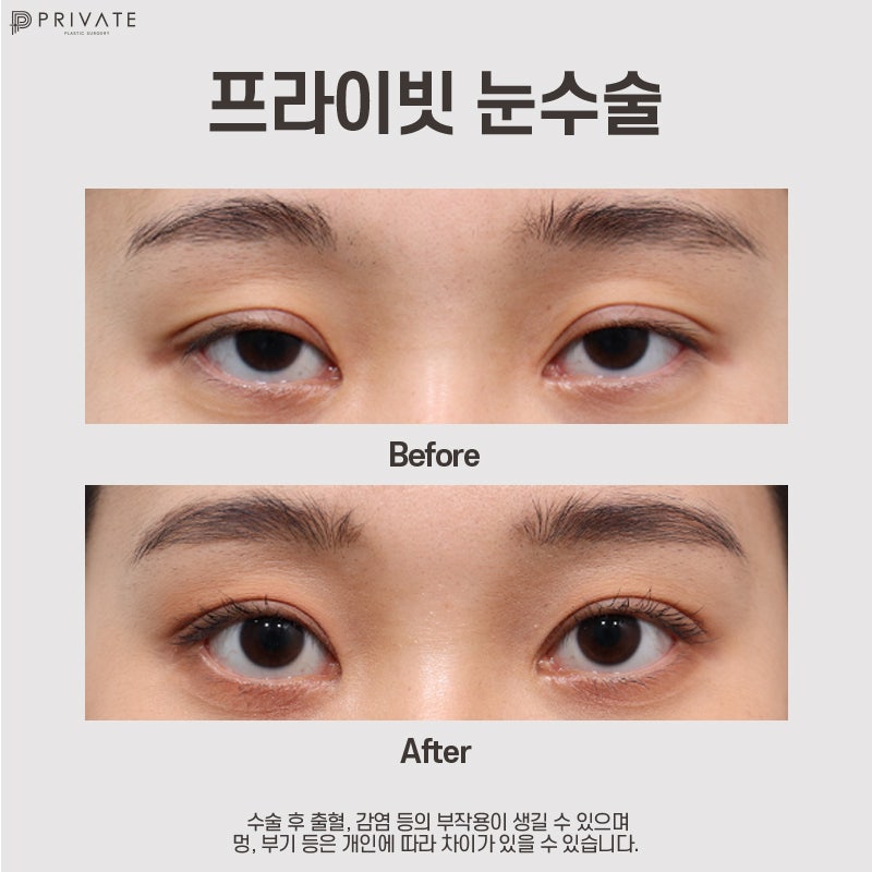 Perbandingan ulasan operasi koreksi mata di Private Plastic Surgery adalah yang terbaik 사진 9