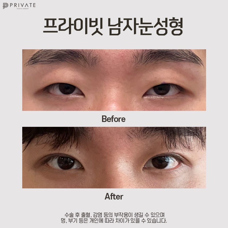 Operasi Mata Pria di Private Plastic Surgery 사진 8