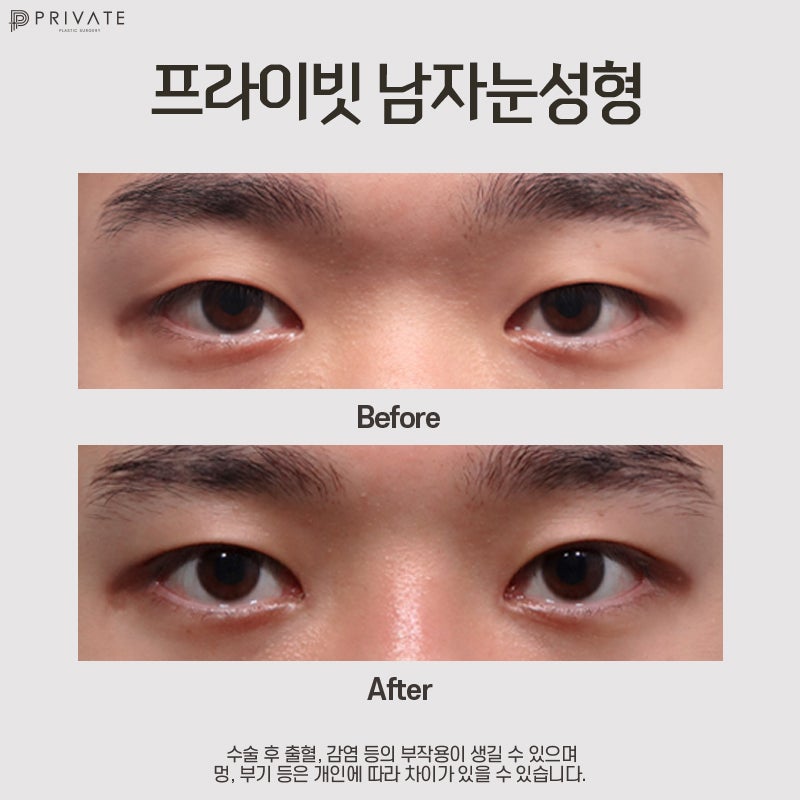 Operasi Mata Pria di Private Plastic Surgery 사진 7