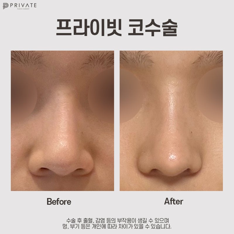 Klinik Bedah Plastik Sinsa-dong, Tempat Terbaik untuk Mengecilkan Cuping Hidung 사진 9
