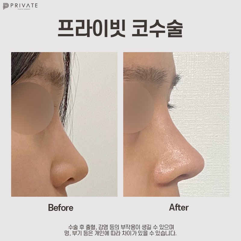 Klinik Bedah Plastik Sinsa-dong, Tempat Terbaik untuk Mengecilkan Cuping Hidung 사진 10