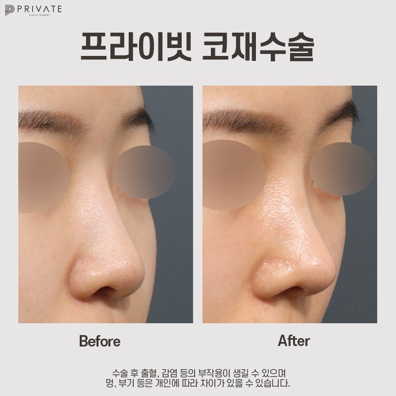 신사역 코재수술잘하는곳 프라이빗성형외과 사진 8