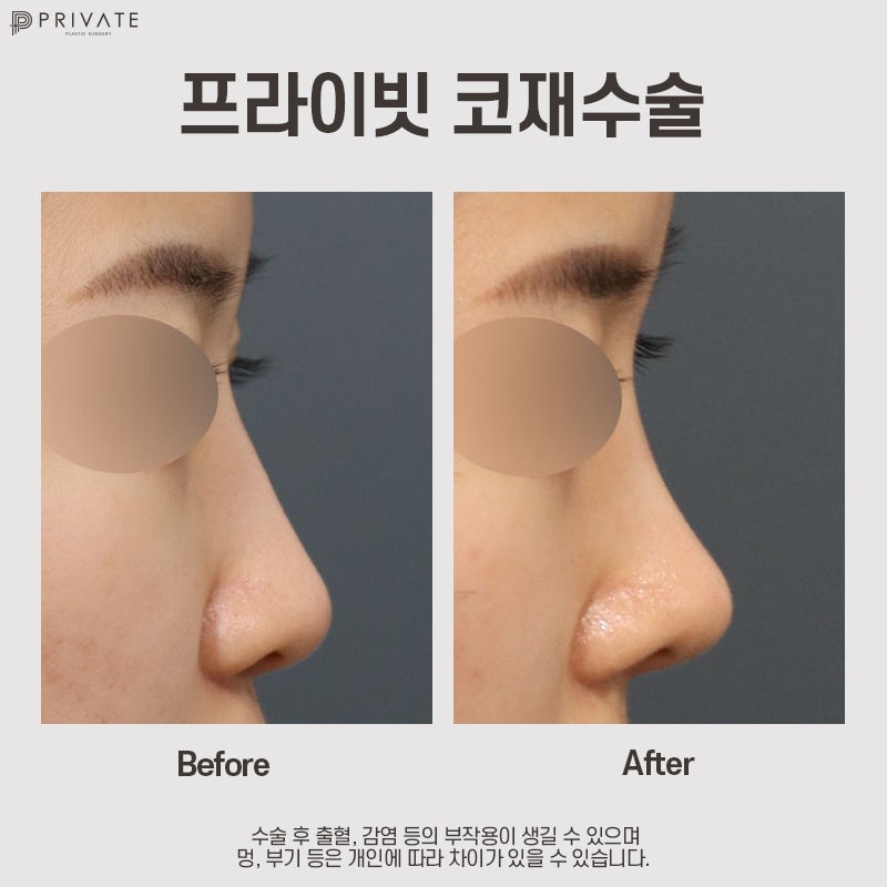 신사역 코재수술잘하는곳 프라이빗성형외과 사진 10