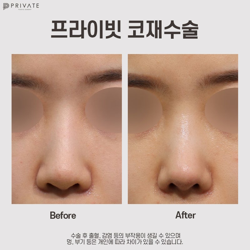 신사역 코재수술잘하는곳 프라이빗성형외과 사진 9