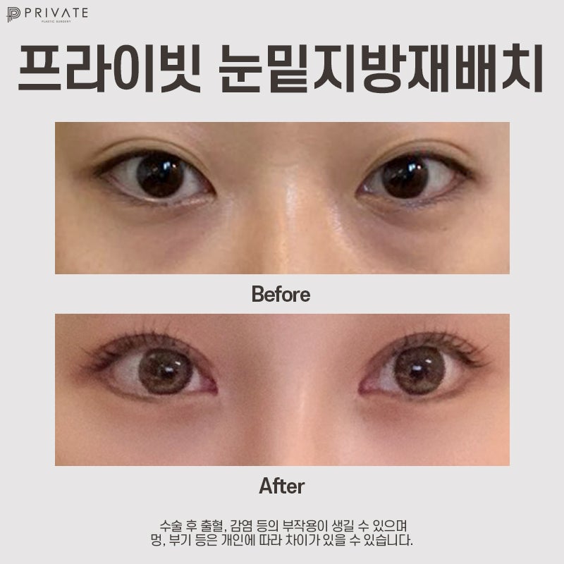 Operasi Penataan Ulang Lemak Bawah Mata di Private Plastic Surgery 사진 7