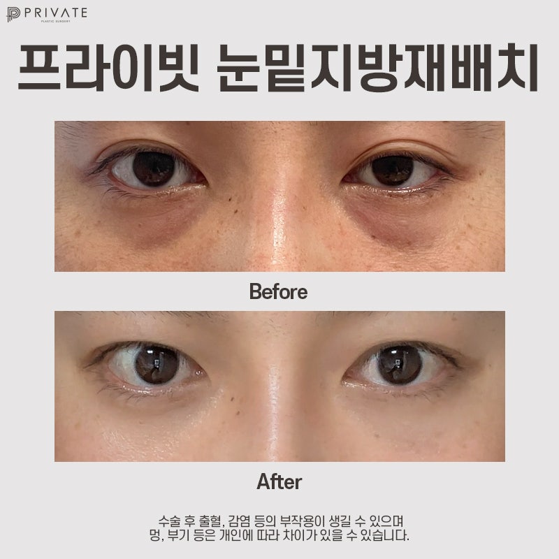 Operasi Penataan Ulang Lemak Bawah Mata di Private Plastic Surgery 사진 8