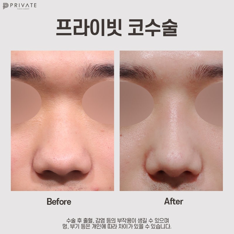 프라이빗성형외과 남자코끝성형수술 사진 9