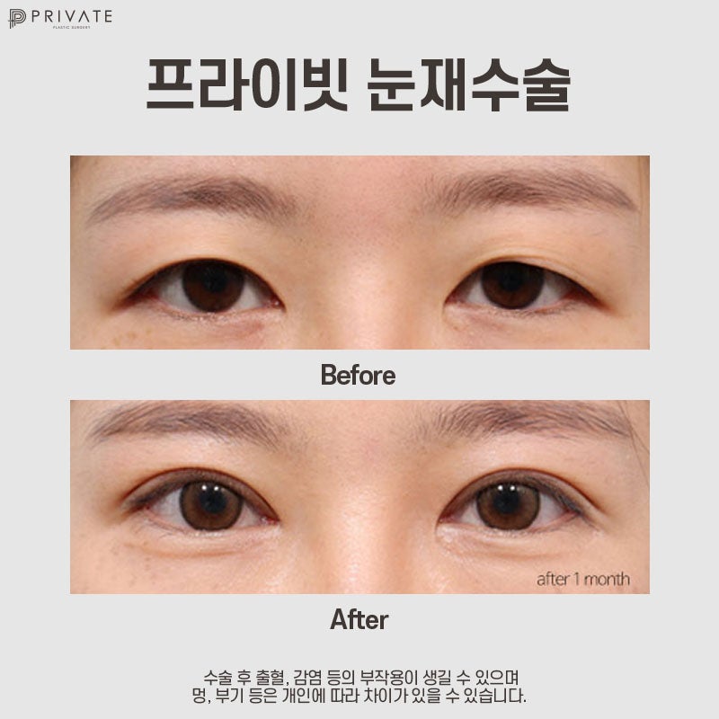 신사 눈재수술잘하는곳 프라이빗성형외과 알아보기 사진 8