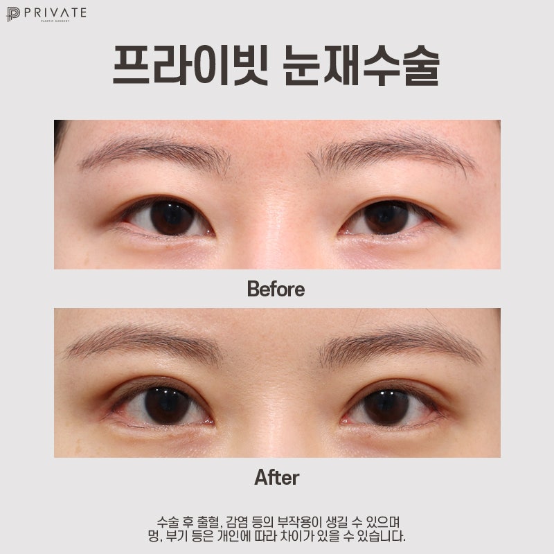 신사 눈재수술잘하는곳 프라이빗성형외과 알아보기 사진 9