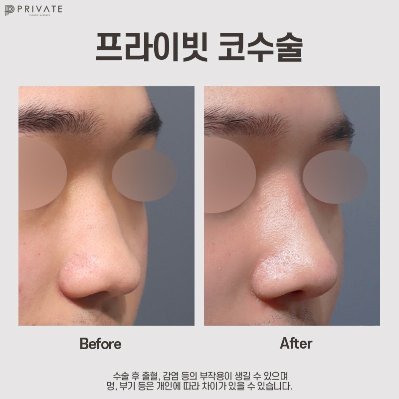 Klinik Bedah Plastik Swasta dengan Ulasan Bagus untuk Operasi Ujung Hidung 사진 10