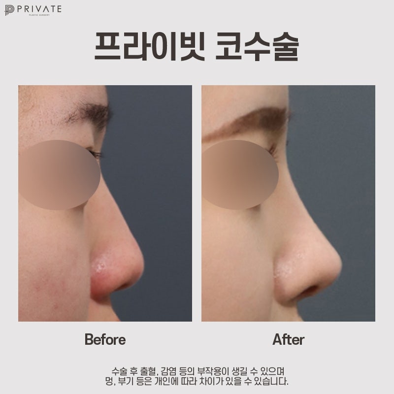 Klinik Bedah Plastik Swasta dengan Ulasan Bagus untuk Operasi Ujung Hidung 사진 9