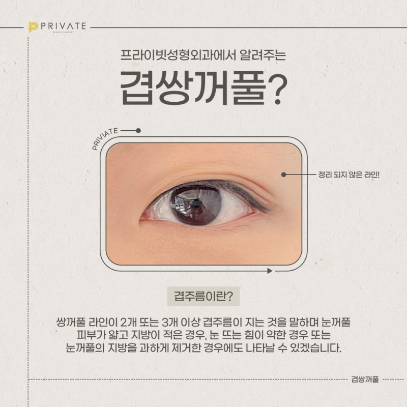 겹쌍커풀수술은 프라이빗성형외과