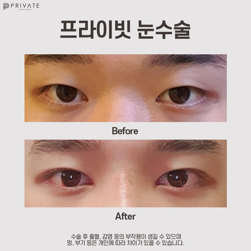 Operasi Mata Pria di Private Plastic Surgery 사진 8