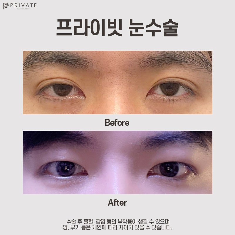 Operasi Mata Pria di Private Plastic Surgery 사진 7