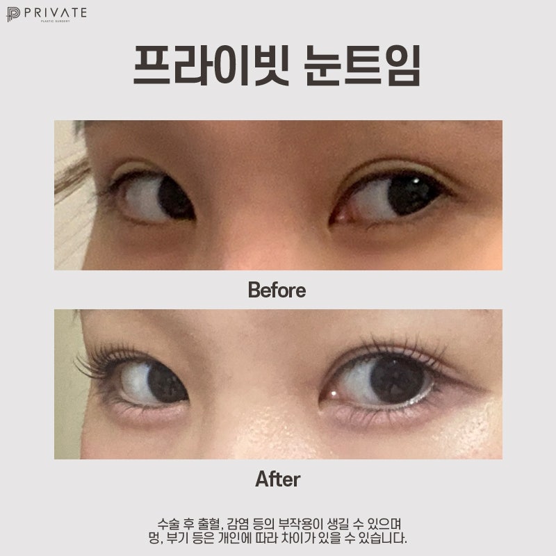 Operasi Plastik Full Trimming di Private Plastic Surgery 사진 9