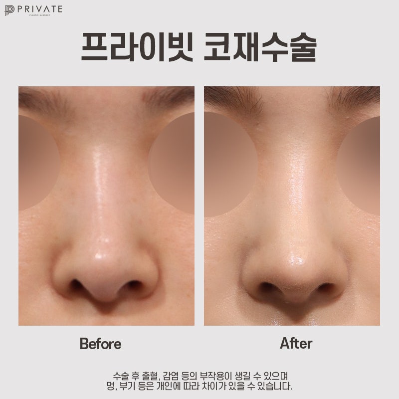 코재수술성형외과 프라이빗성형외과 추천 사진 9