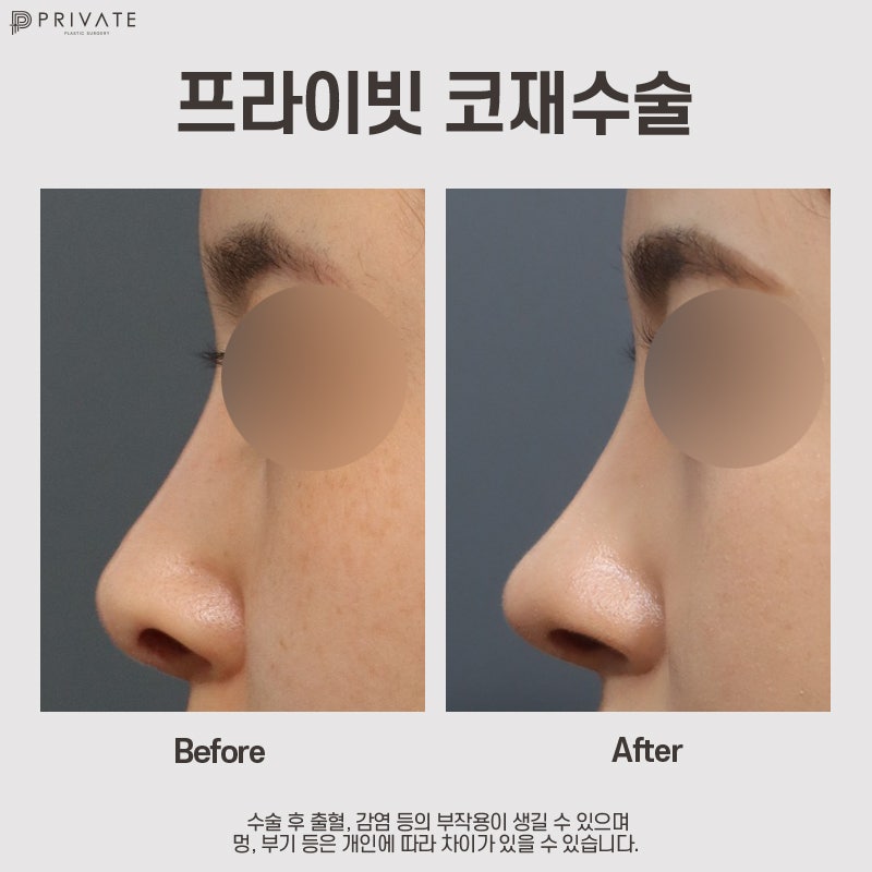 코재수술성형외과 프라이빗성형외과 추천 사진 11