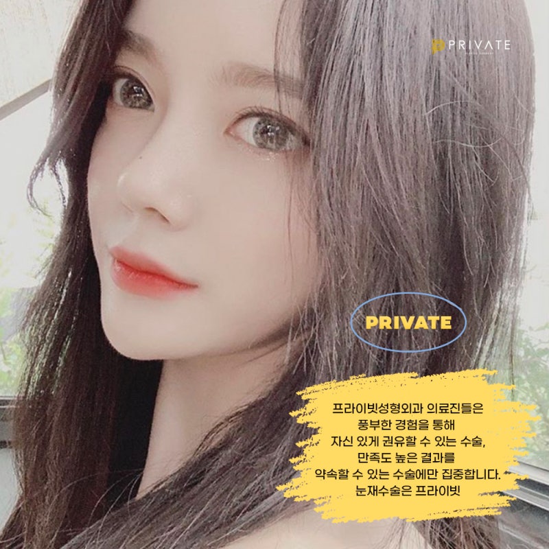 쌍수 재수술 후기가 좋은 프라이빗성형외과 사진 8