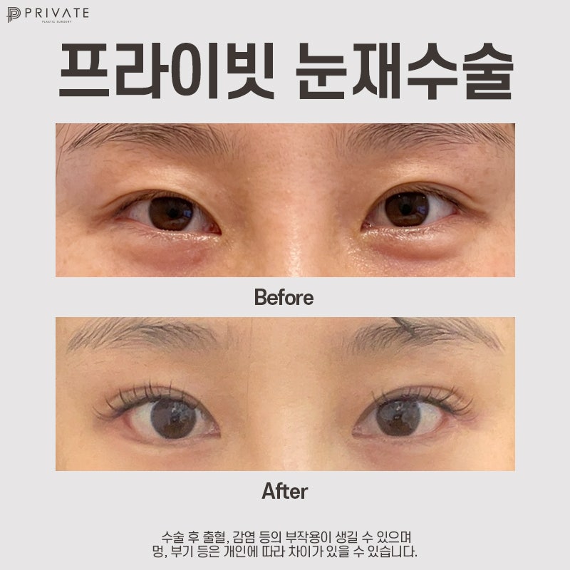 쌍수 재수술 후기가 좋은 프라이빗성형외과 사진 9