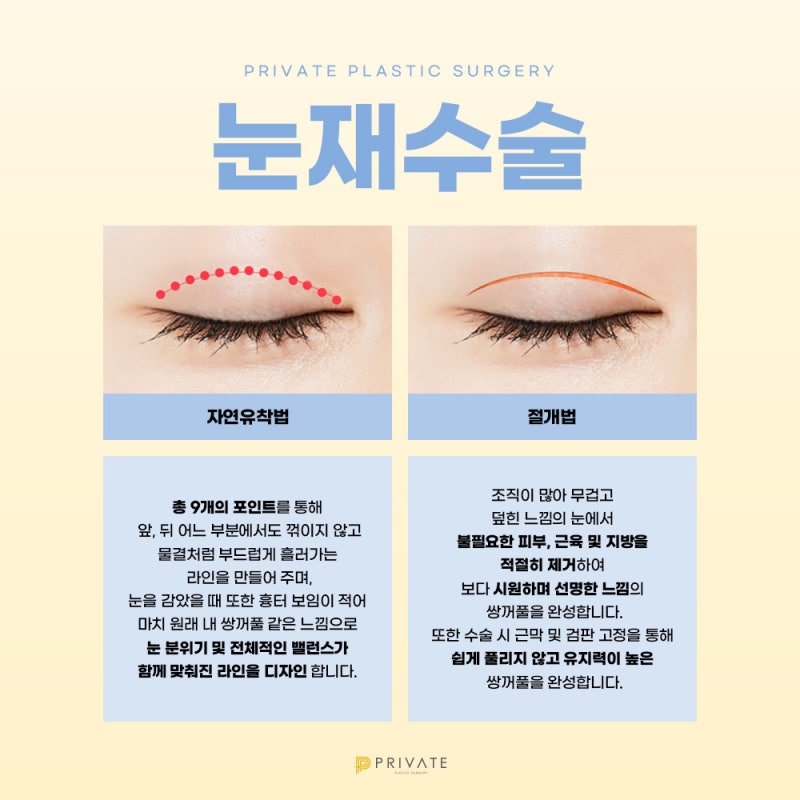 쌍수 재수술 후기가 좋은 프라이빗성형외과 사진 4