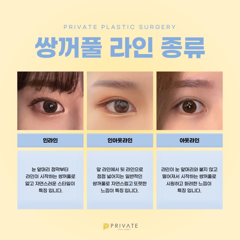 쌍수 재수술 후기가 좋은 프라이빗성형외과 사진 5