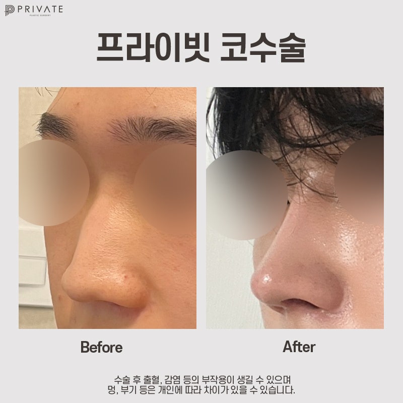 코수술 자가늑, 프라이빗성형외과에서 알아보기 사진 8