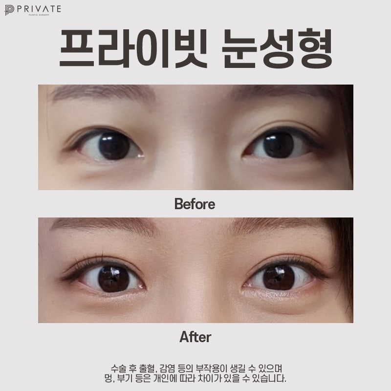 눈성형잘하는병원 신사역 프라이빗성형외과 사진 9