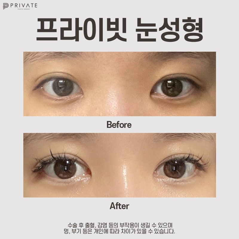 눈성형잘하는병원 신사역 프라이빗성형외과 사진 8