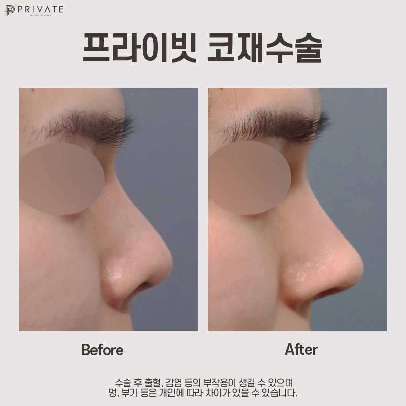 男性の鼻の再手術ならプライベート美容外科 사진 9