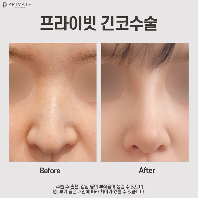 Tempat Terbaik untuk Operasi Hidung Panjang adalah Private Plastic Surgery 사진 8