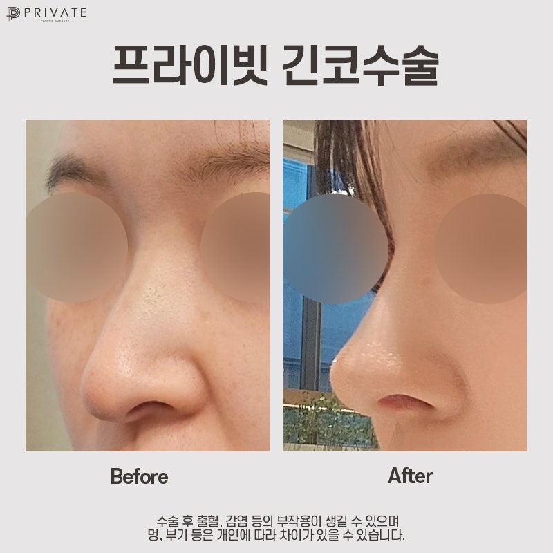 Tempat Terbaik untuk Operasi Hidung Panjang adalah Private Plastic Surgery 사진 9