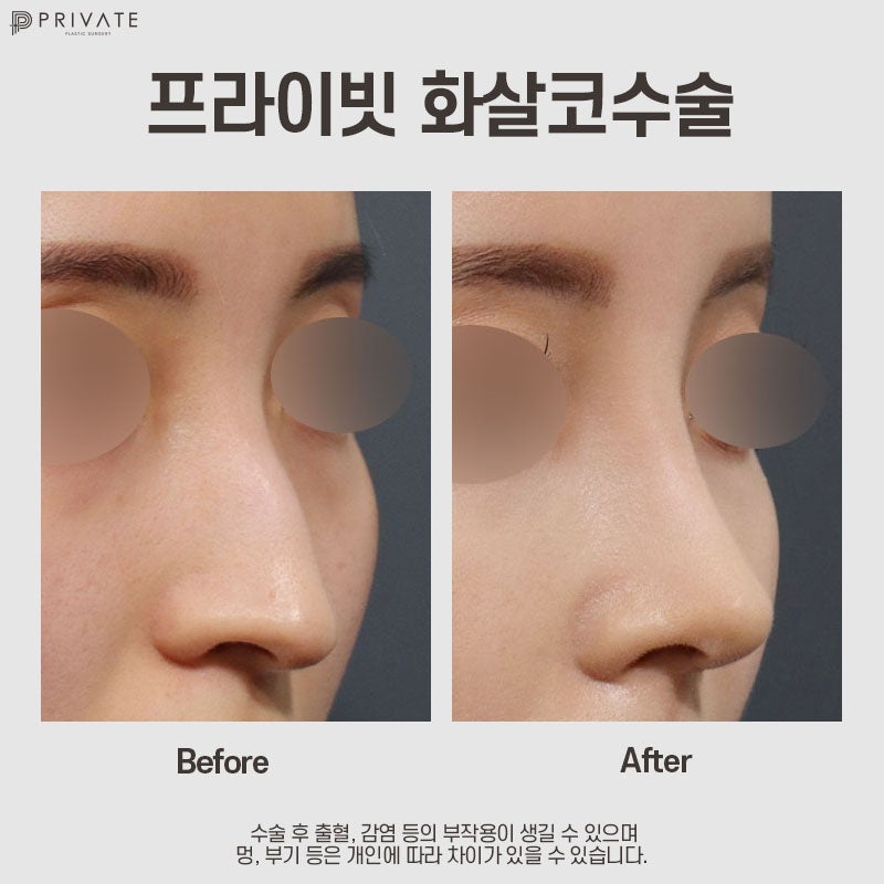 화살코성형후기가 좋은 프라이빗성형외과 사진 10