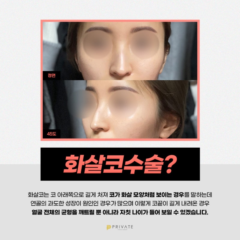 화살코성형후기가 좋은 프라이빗성형외과