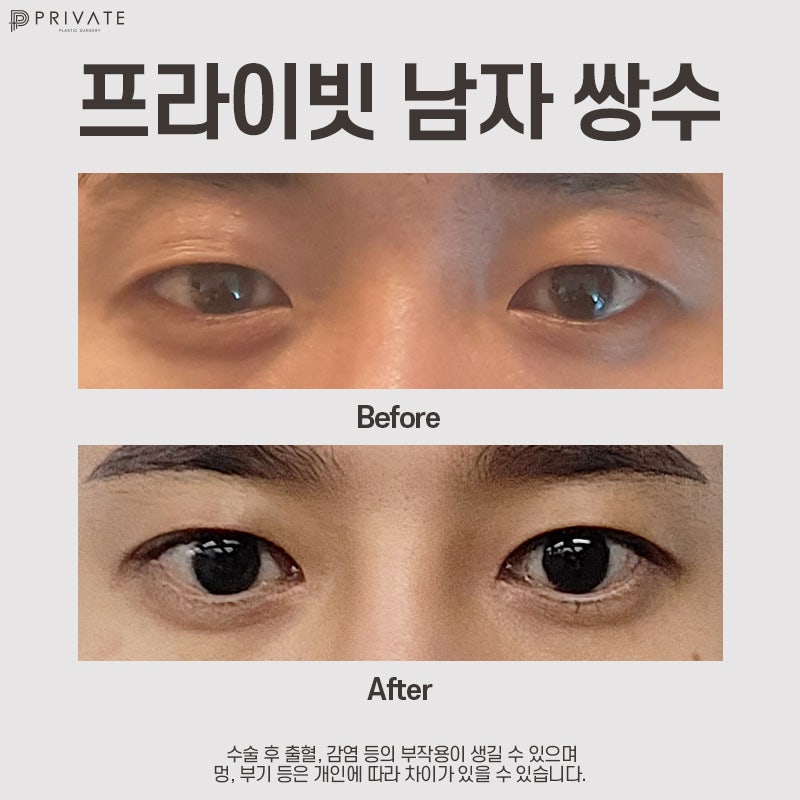 Tempat dengan ulasan operasi kelopak mata ganda pria yang bagus, Private Plastic Surgery 사진 9