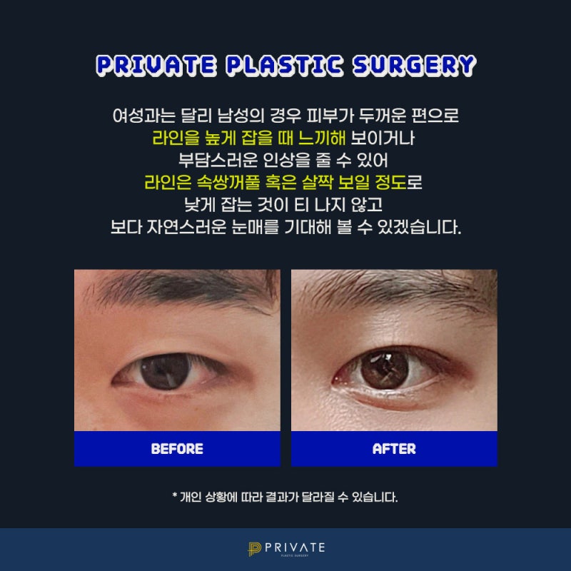 Tempat dengan ulasan operasi kelopak mata ganda pria yang bagus, Private Plastic Surgery