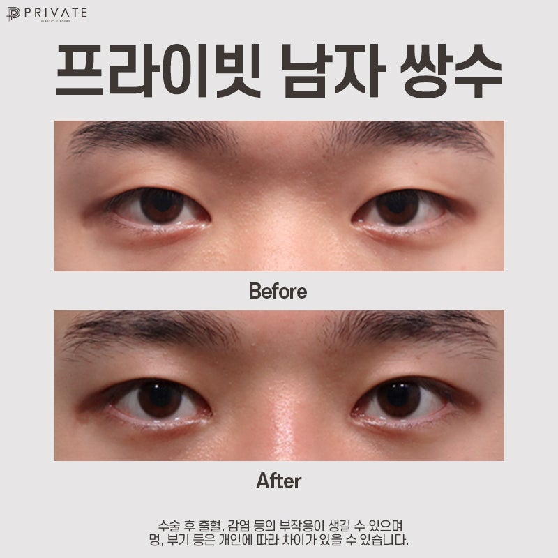 Tempat dengan ulasan operasi kelopak mata ganda pria yang bagus, Private Plastic Surgery 사진 10