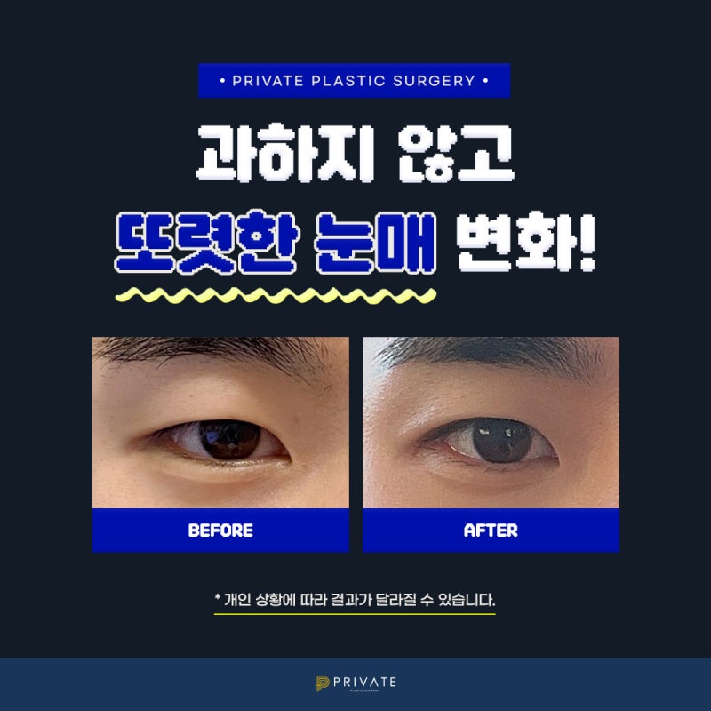 Tempat dengan ulasan operasi kelopak mata ganda pria yang bagus, Private Plastic Surgery 사진 7