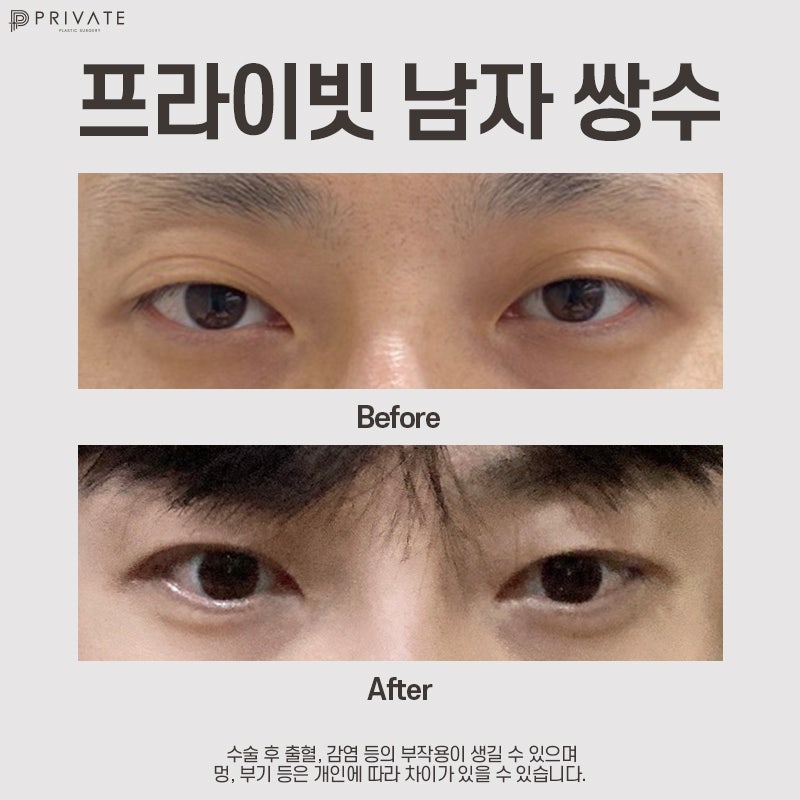 Tempat dengan ulasan operasi kelopak mata ganda pria yang bagus, Private Plastic Surgery 사진 8