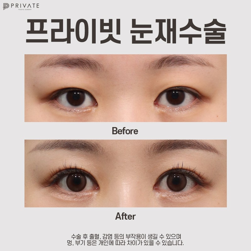 쌍수 재수술 후기 좋은 곳 찾고 있다면 프라이빗성형외과 사진 9