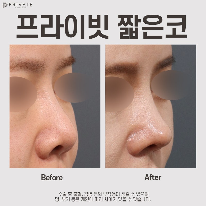 Operasi Rhinoplasty Hidung Pendek di Sinsa Private Plastic Surgery 사진 9