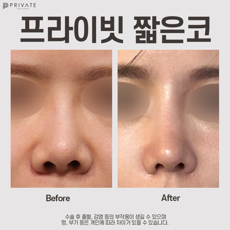 Operasi Rhinoplasty Hidung Pendek di Sinsa Private Plastic Surgery 사진 7