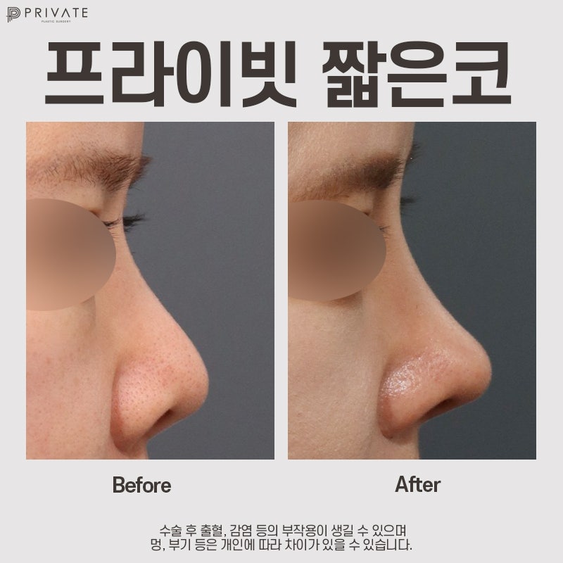 Operasi Rhinoplasty Hidung Pendek di Sinsa Private Plastic Surgery 사진 8
