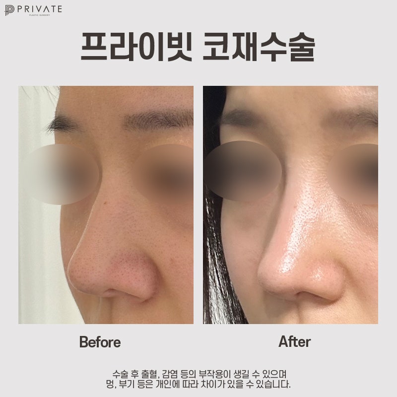 코재수술성형외과는 프라이빗성형외과 사진 8