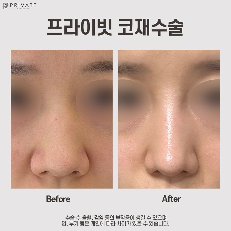 코재수술성형외과는 프라이빗성형외과 사진 7