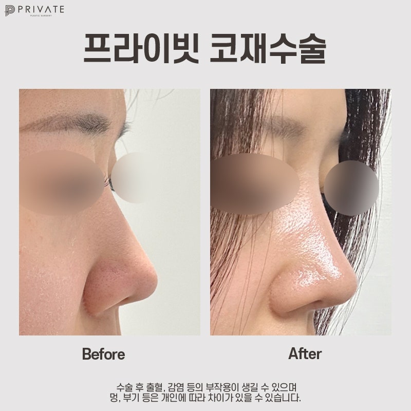 코재수술성형외과는 프라이빗성형외과 사진 9