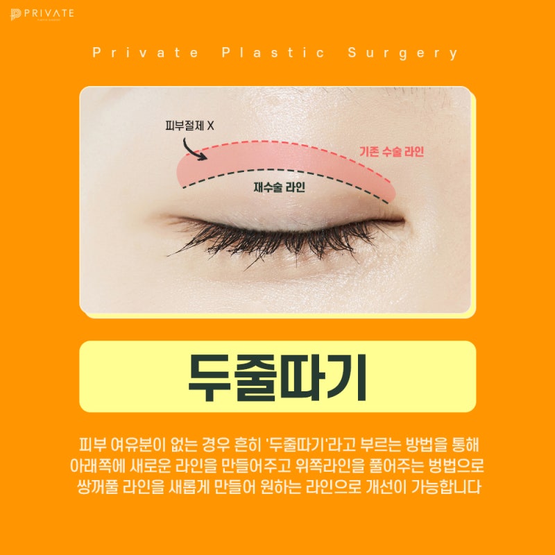 소세지눈 재수술 후기가 좋은 프라이빗성형외과 사진 4