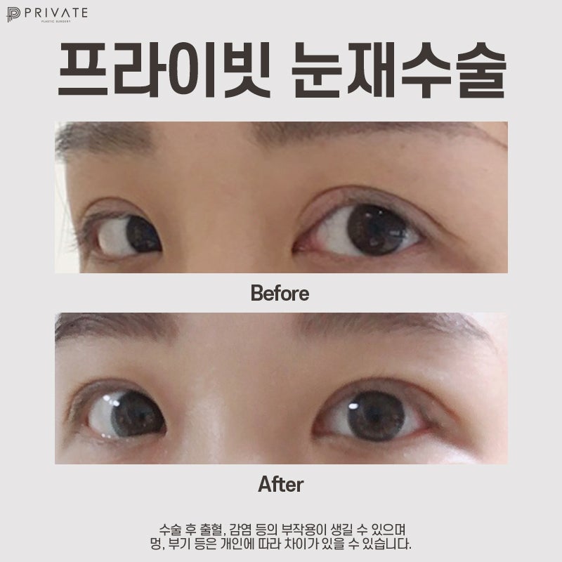 소세지눈 재수술 후기가 좋은 프라이빗성형외과 사진 10